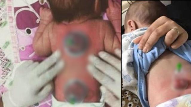 2 aylık bebeğe hacamat yapılan görüntülerin tepki toplaması üzerine uzmanlardan uyarı: Çocuklara asla yapılmamalı