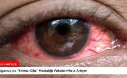 Uganda’da “Kırmızı Göz” Hastalığı Vakaları Hızla Artıyor