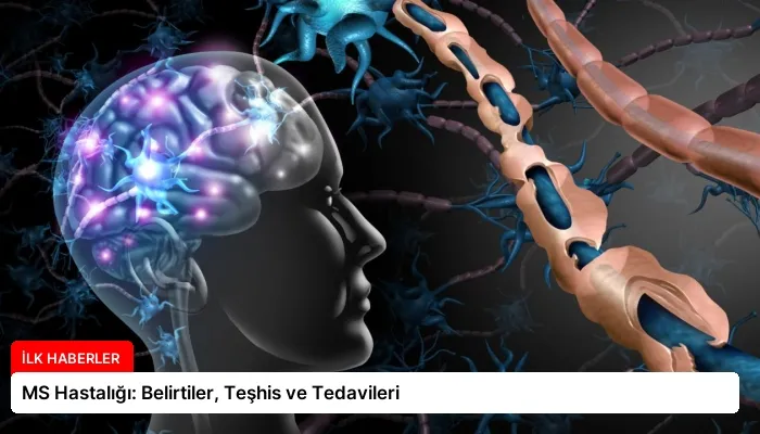 MS Hastalığı: Belirtiler, Teşhis ve Tedavileri