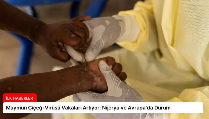 Maymun Çiçeği Virüsü Vakaları Artıyor: Nijerya ve Avrupa’da Durum
