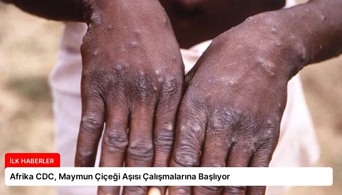 Afrika CDC, Maymun Çiçeği Aşısı Çalışmalarına Başlıyor